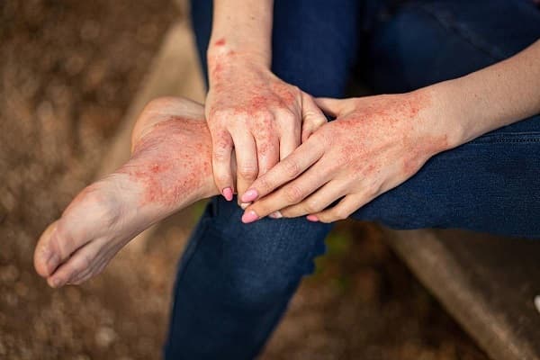 تمامی آنچه باید از لوپوس بدانید