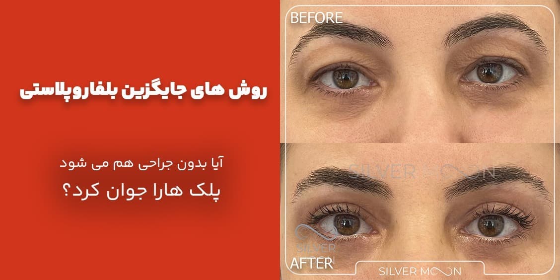 روش‌های جایگزین بلفاروپلاستی؛ آیا بدون جراحی هم می‌شود پلک‌ها را جوان کرد؟