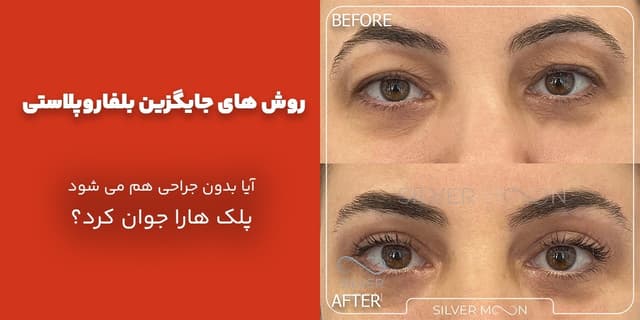 روش‌های جایگزین بلفاروپلاستی؛ آیا بدون جراحی هم می‌شود پلک‌ها را جوان کرد؟