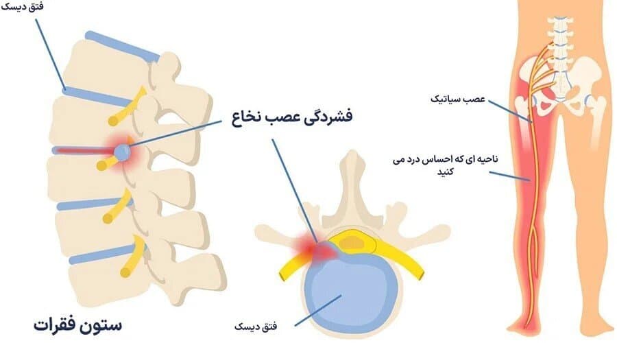 تفاوت دیسک کمر و عصب سیاتیک چیست؟