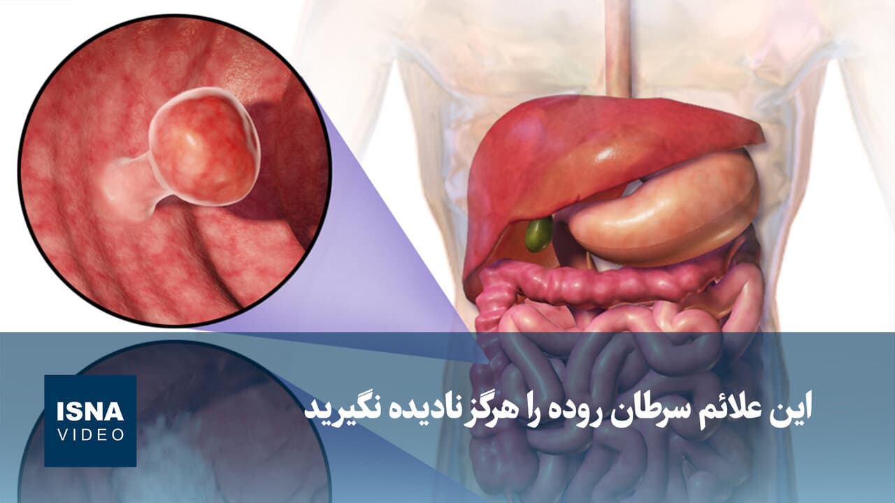 ویدیو/ این علائم سرطان روده را هرگز نادیده نگیرید
