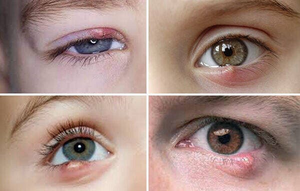 گلمژه؛ از درمانهای ساده تا خطاهای خطرناک