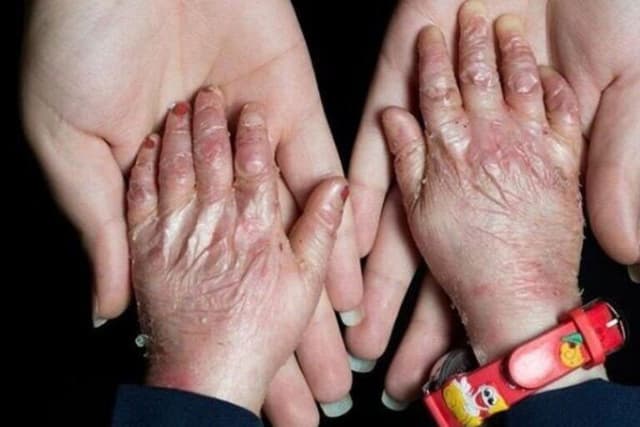 حدود ۲ میلیون بیمار خاص و صعب‌العلاج تحت پوشش بیمه‌ پایه هستند