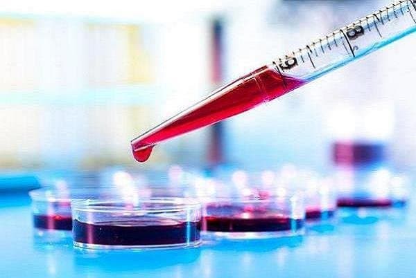تشخیص کبد چرب الکلی با آزمایش خون