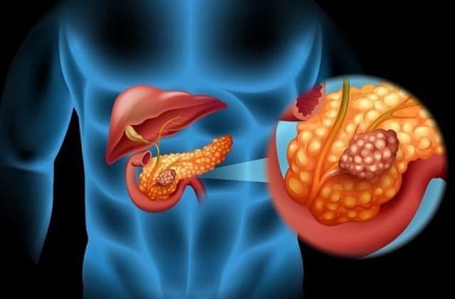 ارتباط متابولیسم اسید صفراوی با پیشآگهی از سرطان کولورکتال