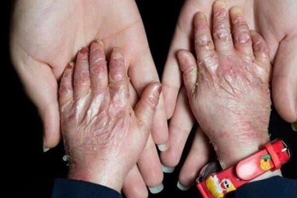 افزودن ۲۵ بیماری جدید به فهرست بیماریهای نادر