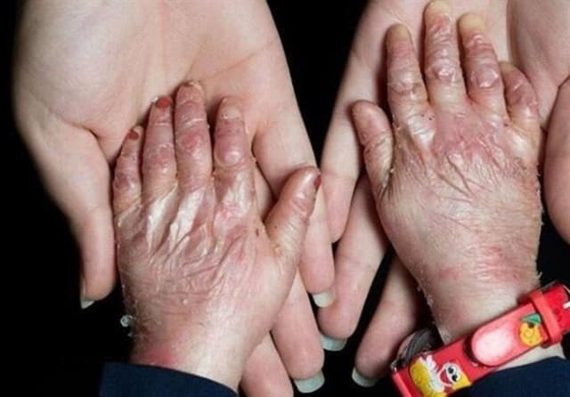 شناسایی 492 گونه بیماری نادر در ایران/دو سوم بیماری‌ها بیمه نیست