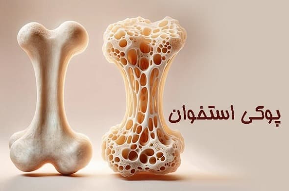 این عوامل بعد از ۳۵ سالگی باعث پوکی استخوان میشوند
