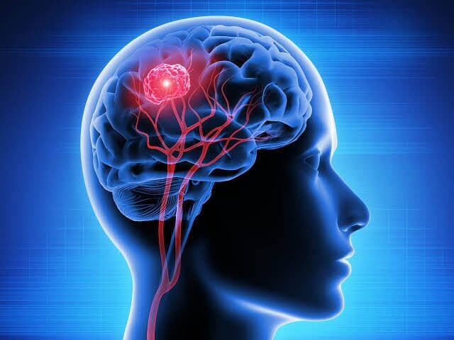 رازهای پیشگیری از سکته از زبان متخصصان مغز و اعصاب