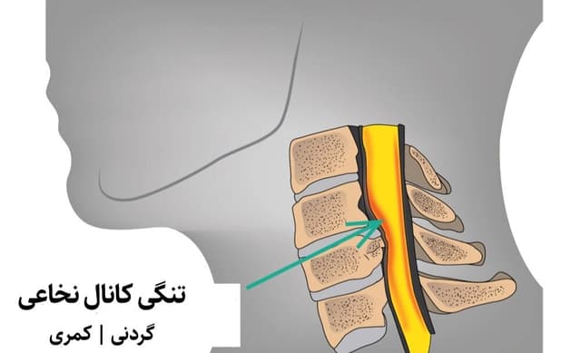 آیا تنگی کانال نخاعی دارید؟ | تشخیص، درمان و انتخاب روش جراحی