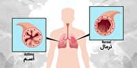 آسم همچنان شایعترین علت بستری کودکان در مراکز درمانی